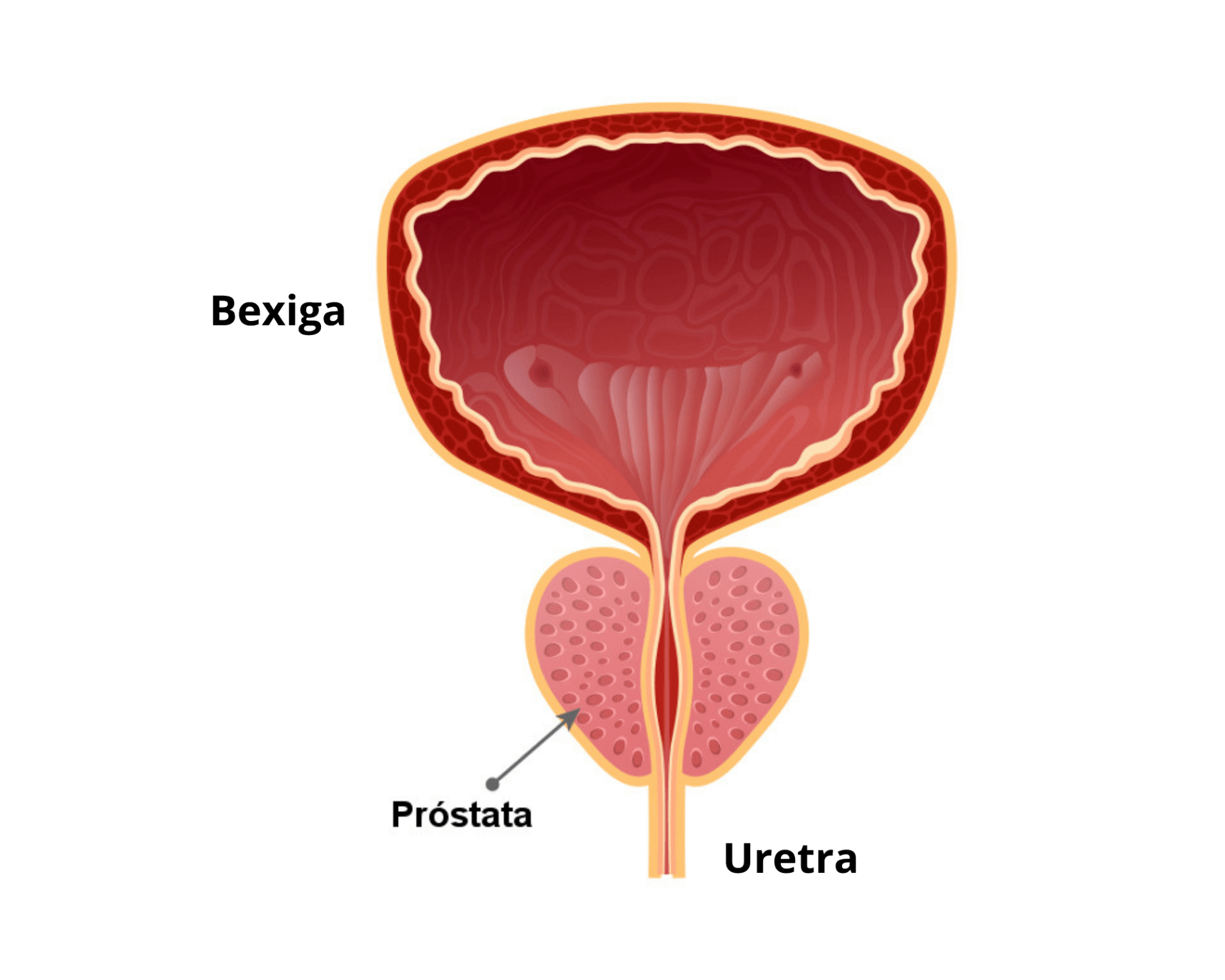 Normal Prostate And Acute Prostatitis Medical Illustration Stock